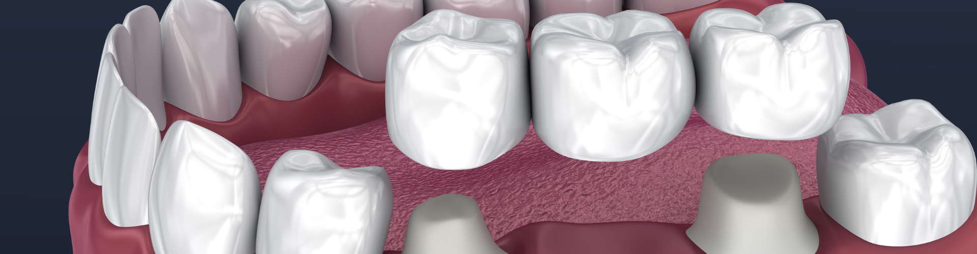 3D render showing dental crowns being placed in the mouth.